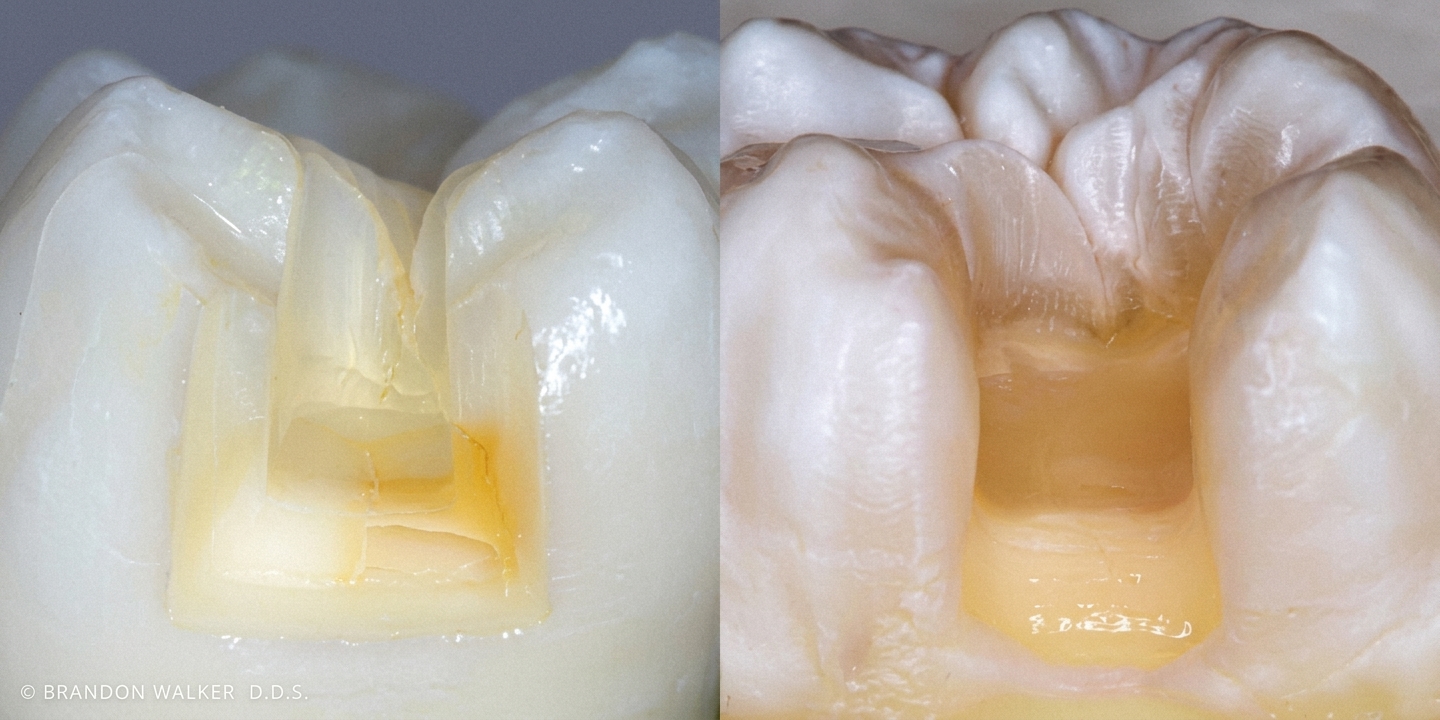 단대오거리역 치과 충치 치료 범위 평가 — 충치 삭제 후 치아 구조 확인
