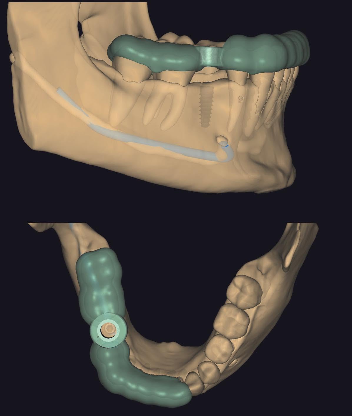 금광동 치과 디지털 가이드 임플란트 CBCT 계획